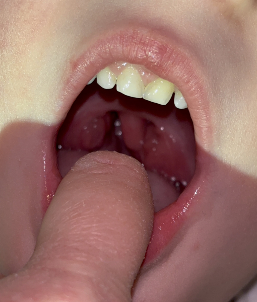Enlarged tonsils and/or adenoids