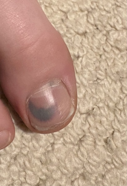Toe caught in door
