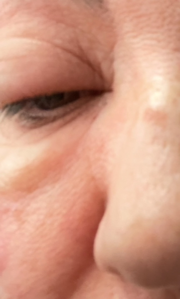 Bad reaction to facial