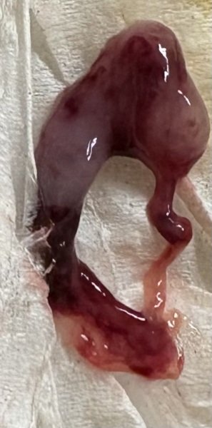 Miscarriage