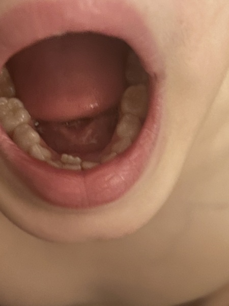 To be worried about my son’s teeth. TW: photo of teeth!