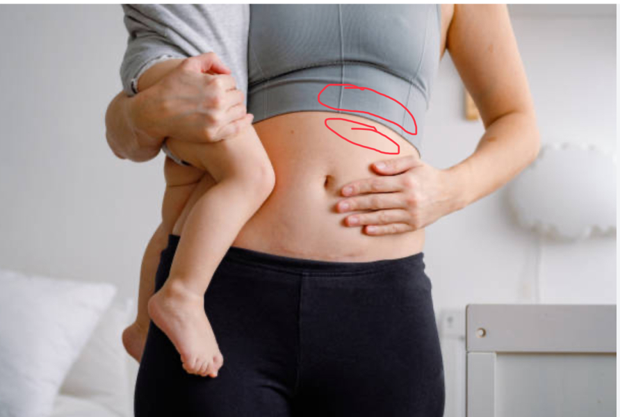 Hard lumps on upper stomach after c section