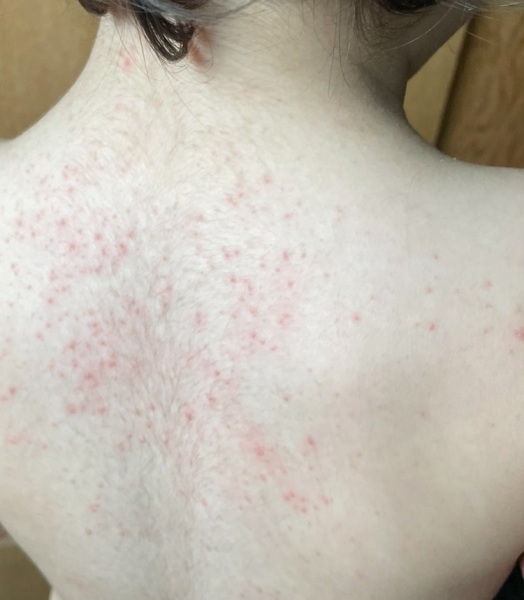 What are these spots all over my toddler? (Pic)