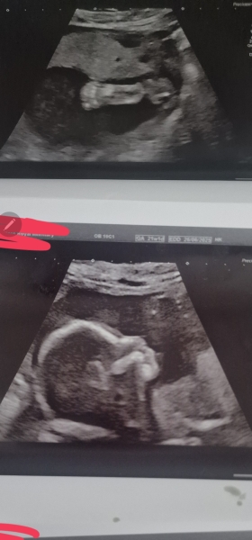 Nub theory 13 weeks then 20 weeks