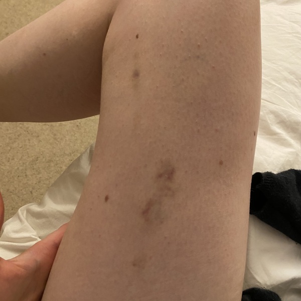 Unexplained bruising - blood test all clear