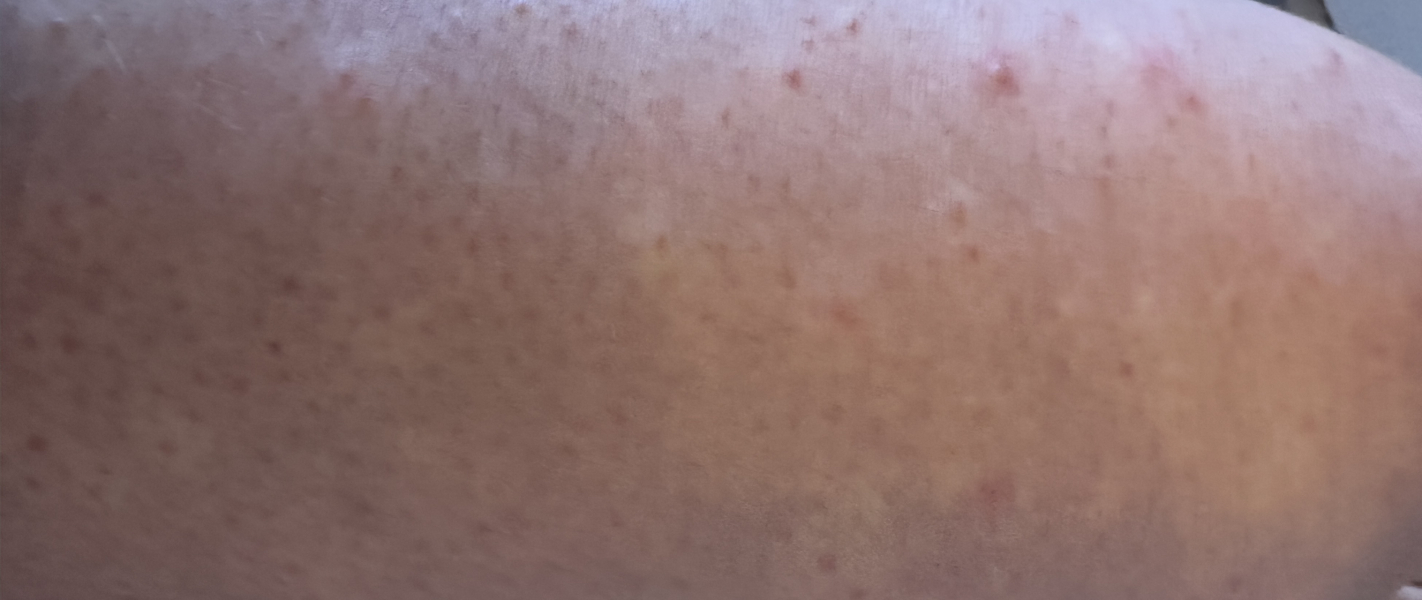 Very itchy spots - bother gp?