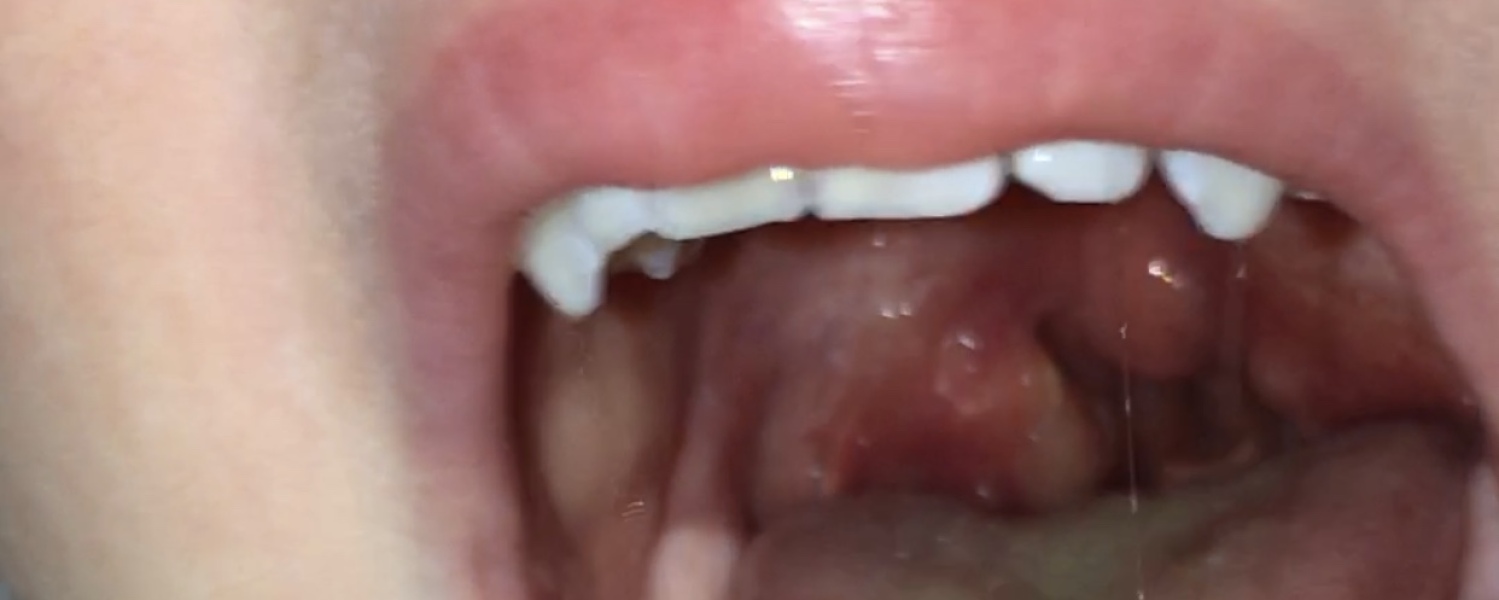 Daughter’s throat- opinions please