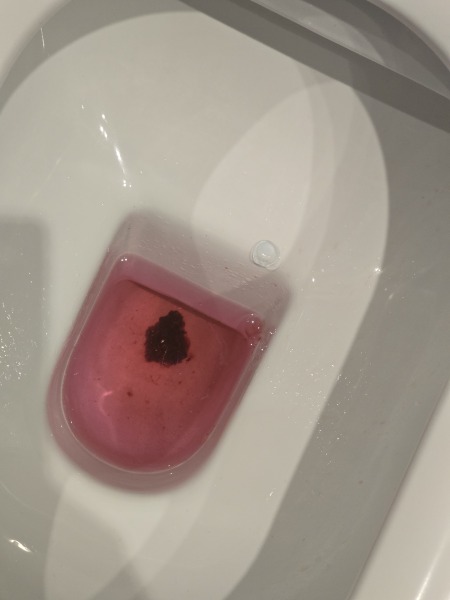Are these clots considered normal? (Warning - photo attached)