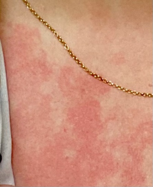 Rash when stressed/anxious