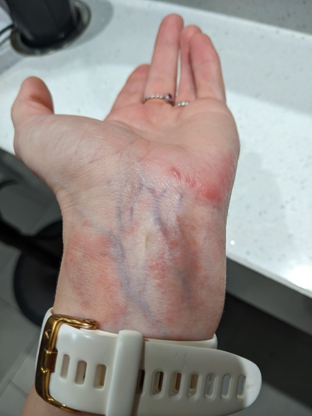 Contact Dermatitis? Please help!