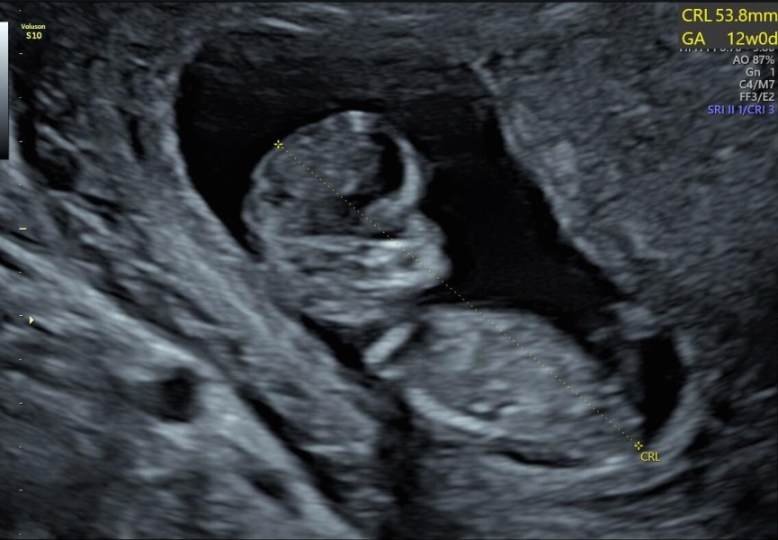 Nub and skull Theory/gender guesses