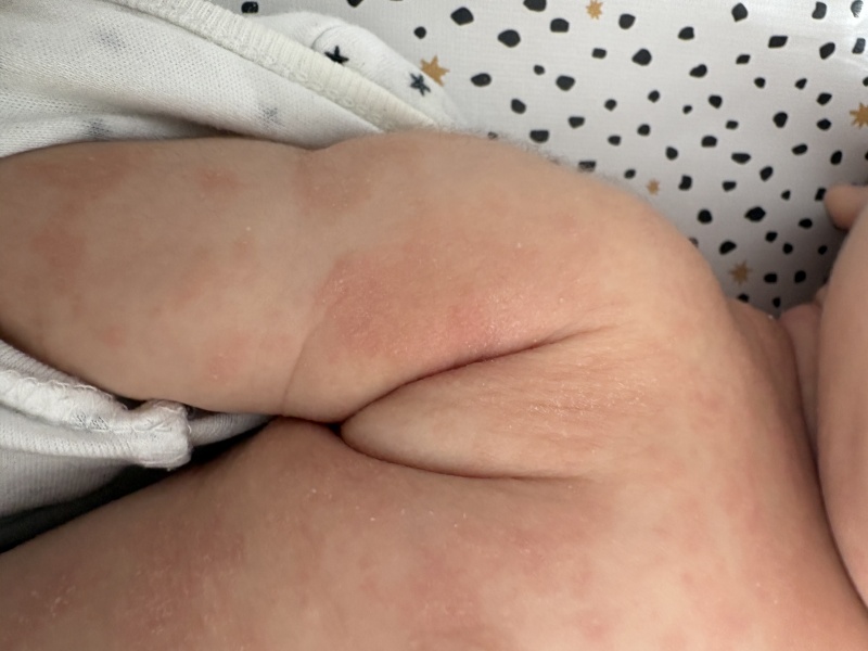 Heat rash or eczema? Or something else?