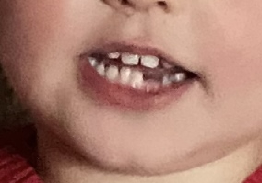 Late toddler teeth eruption .