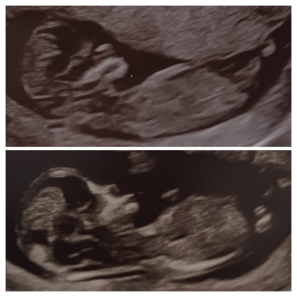 Boy or Girl? Two scan pictures