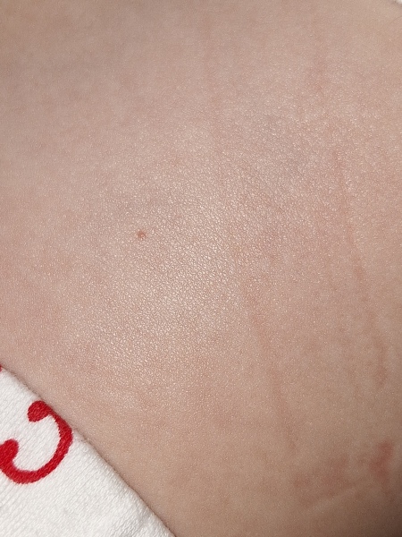 Single chickenpox?