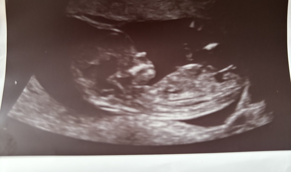 Nub theory - Boy or Girl?