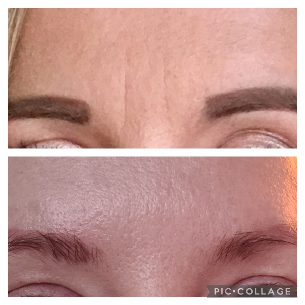 What age did you start Botox?