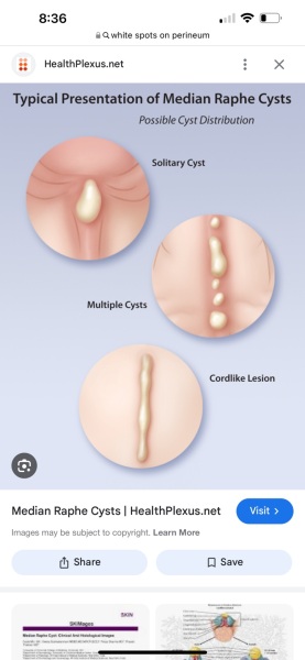 White lump on Perineum