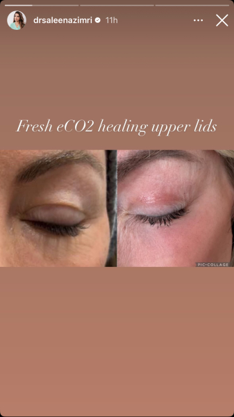 Anyone recommend any treatments for upper eyelids before a blepheroplasty?