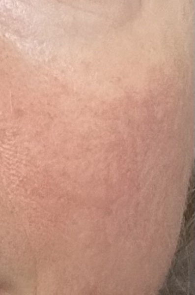 To consider expensive laser for mild rosacea?