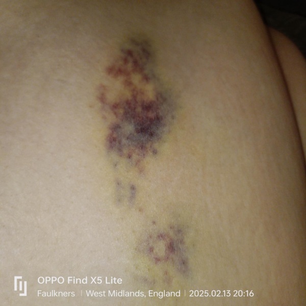 Blood thinners and the bruising