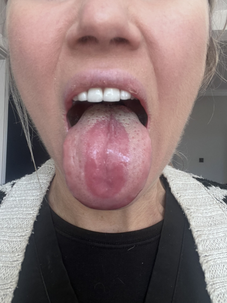 Please can someone tell me what is wrong with my tongue (pic in comments)