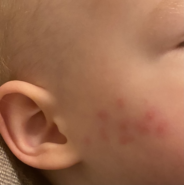 Rash on face