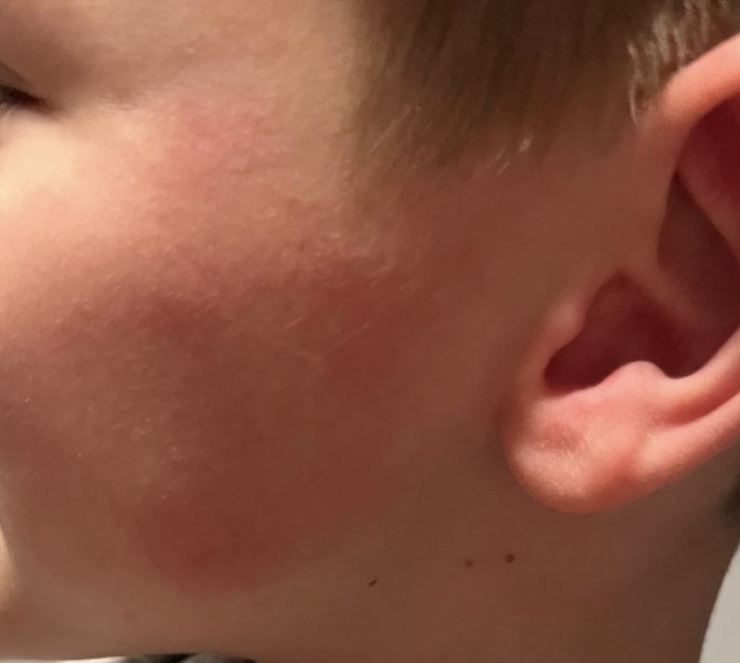 Slapped cheek?