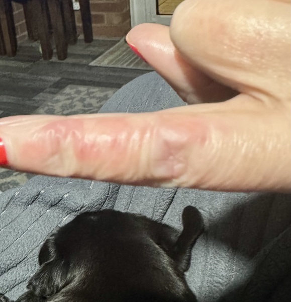 Contact Dermatitis? Please help!