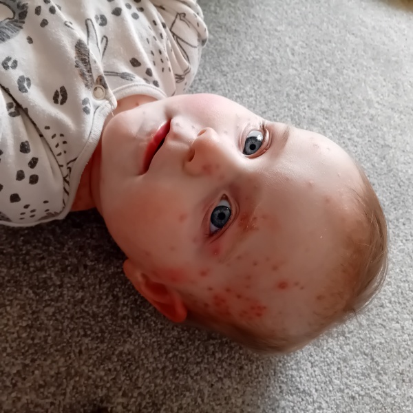 Really bad chickenpox - 9 month old advice please?