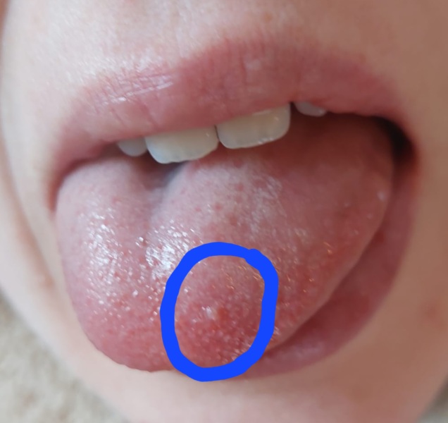 Cold sore on tongue? - newborn fear/OCD