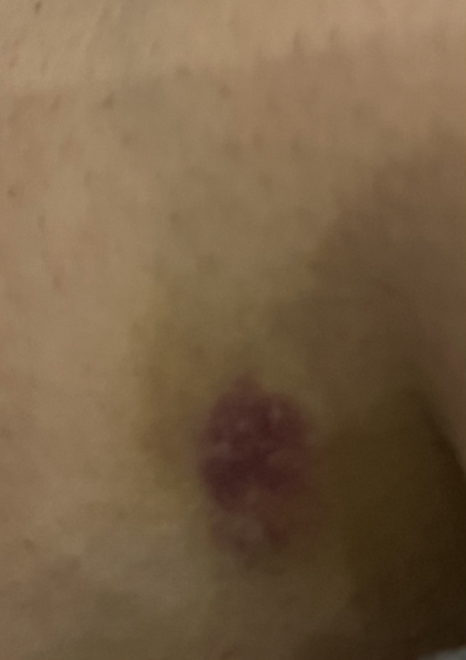 Bruise on leg after dental extraction