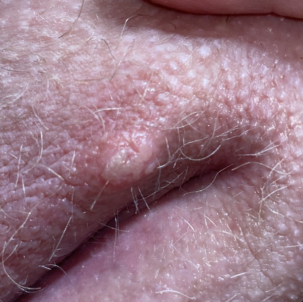 Is this herpes ???? Help i'm panicking *[Content warning: pic included]