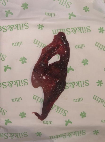 Is this a miscarriage?