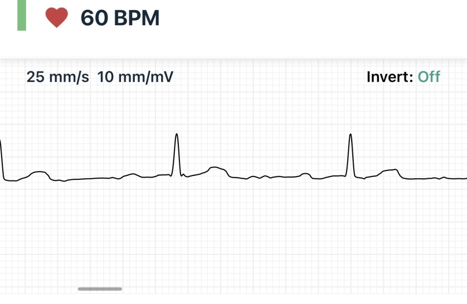 Any DRs/nurses? ECG question?