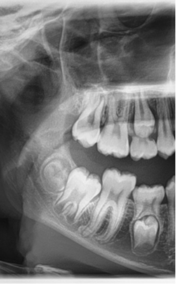 Any dentists about? Tooth X-ray advice pls