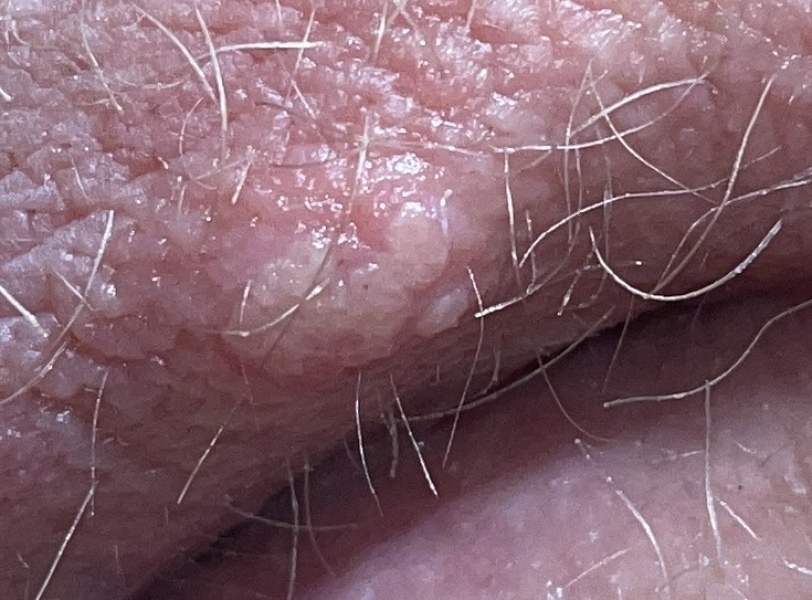 Is this herpes ???? Help i'm panicking *[Content warning: pic included]