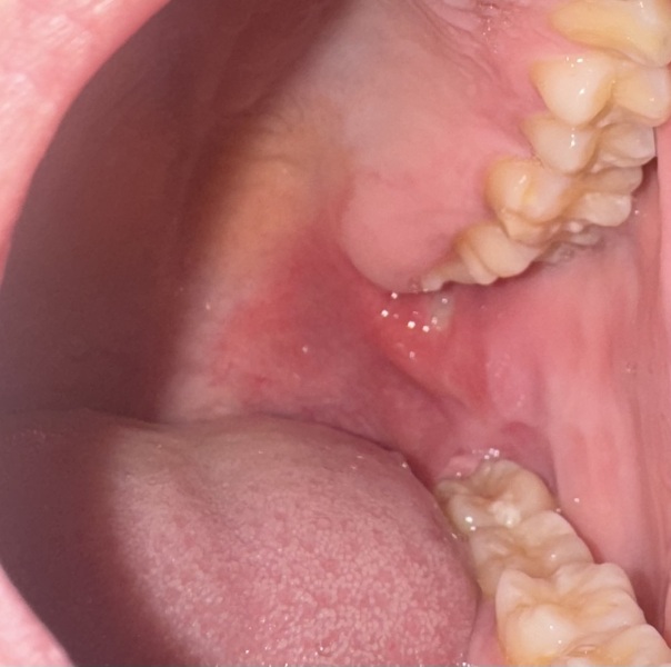 Ulcer or abcess ? Agony!