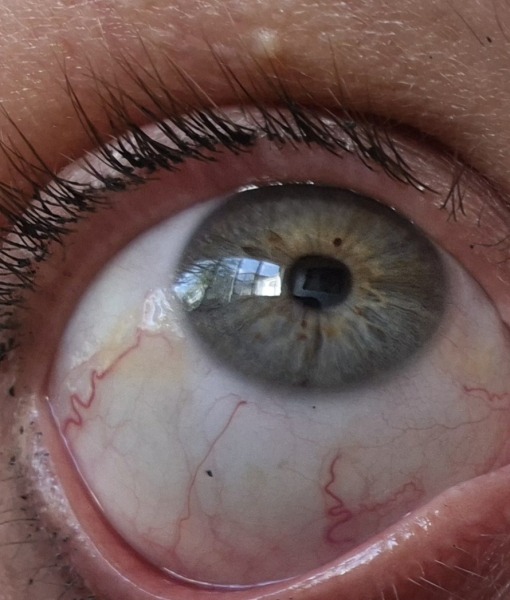 Eye