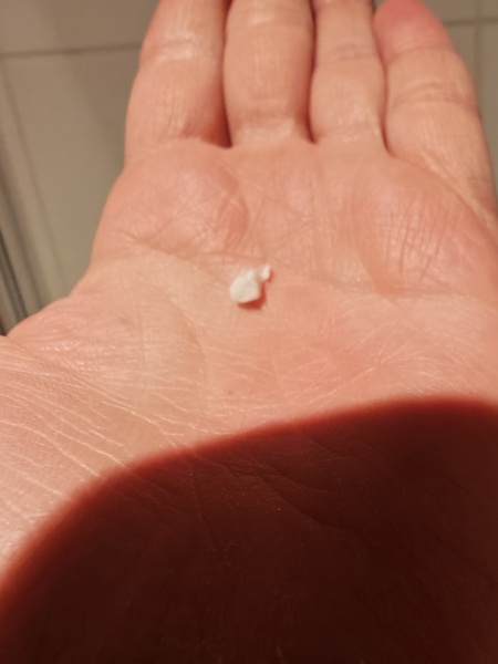 Weight loss and passing a kidney stone every time I wee