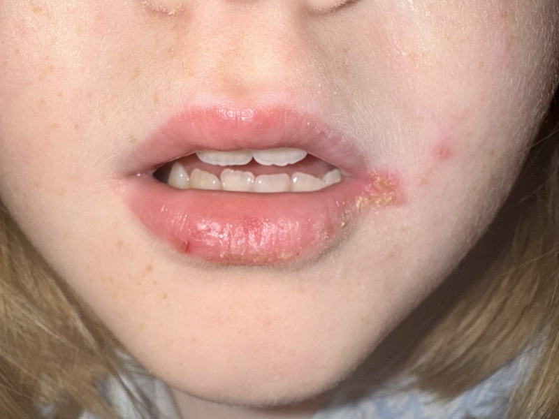 Is this Scarlet Fever, Impetigo or HF&M?