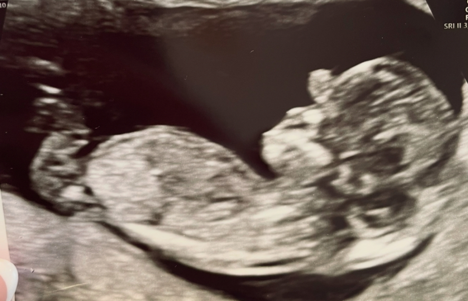 Convinced I was having a boy, nub theory suggests girl? ❤️