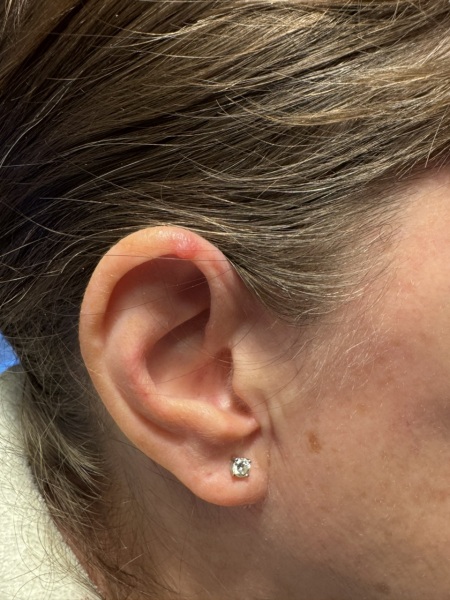 Nodule on ear - should I worry?