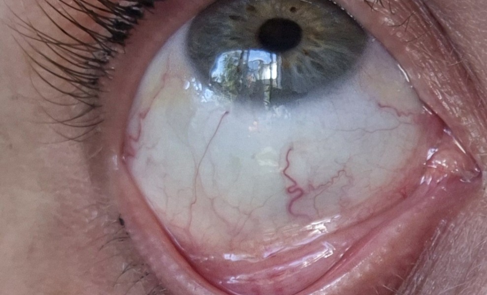 Eye