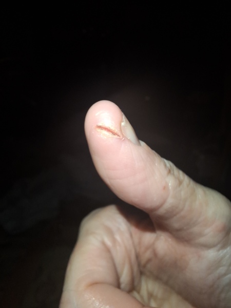 Hand infected (Warning, gross photos)