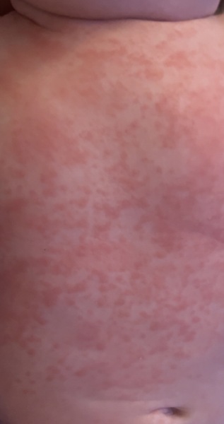 Breastfeeding and Allergies??