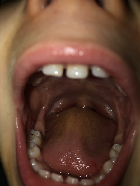 Toddler molar problem potentially