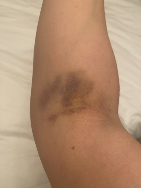 This isn’t normal for a blood test? Warning-pic bruising
