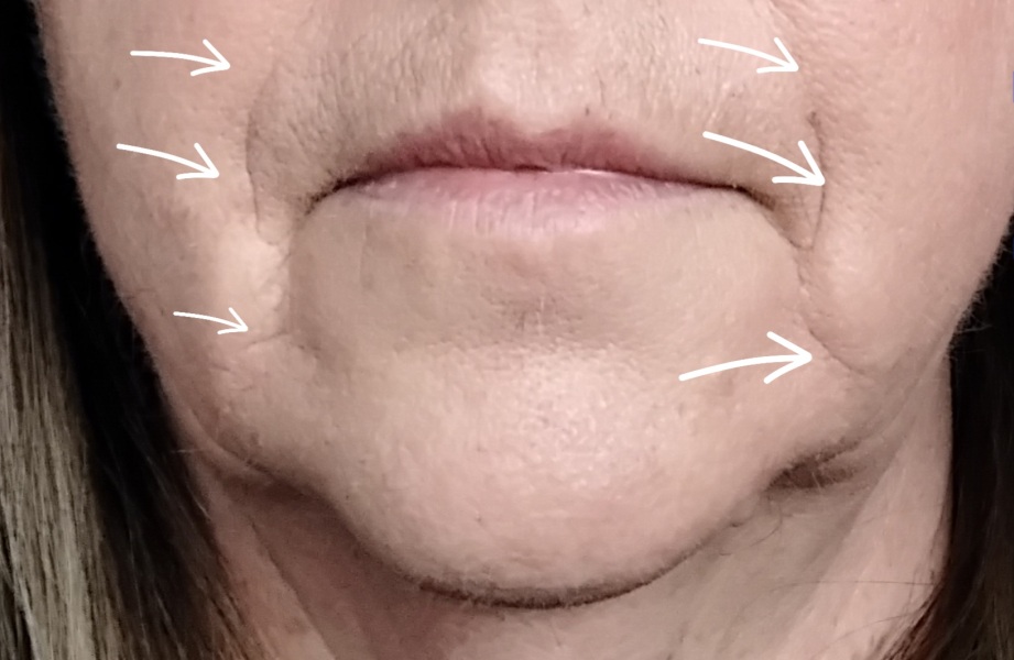 Botox or fillers? Help please