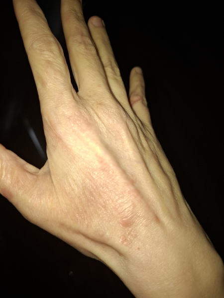 Hand infected (Warning, gross photos)